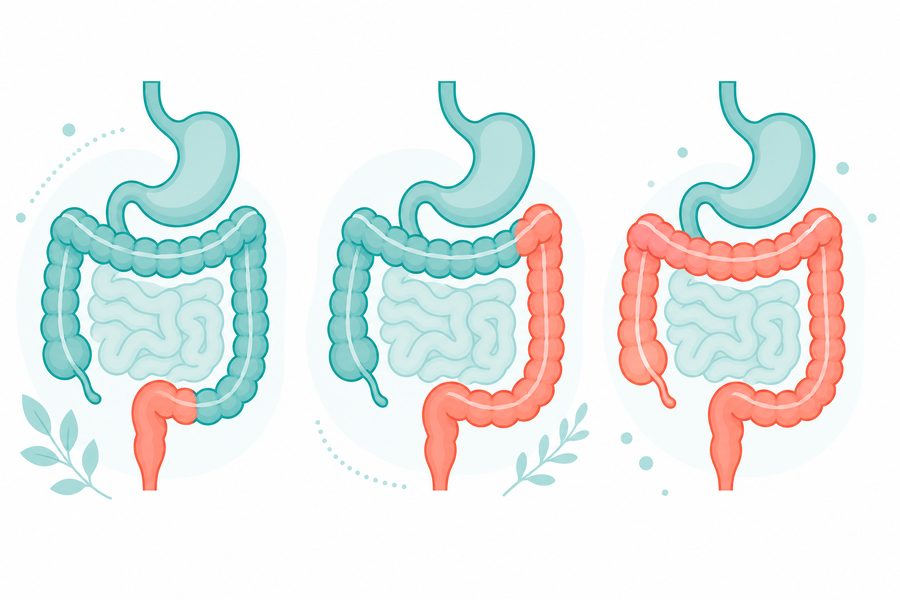 Three diagrams showing proctitis, left-sided colitis, and pancolitis