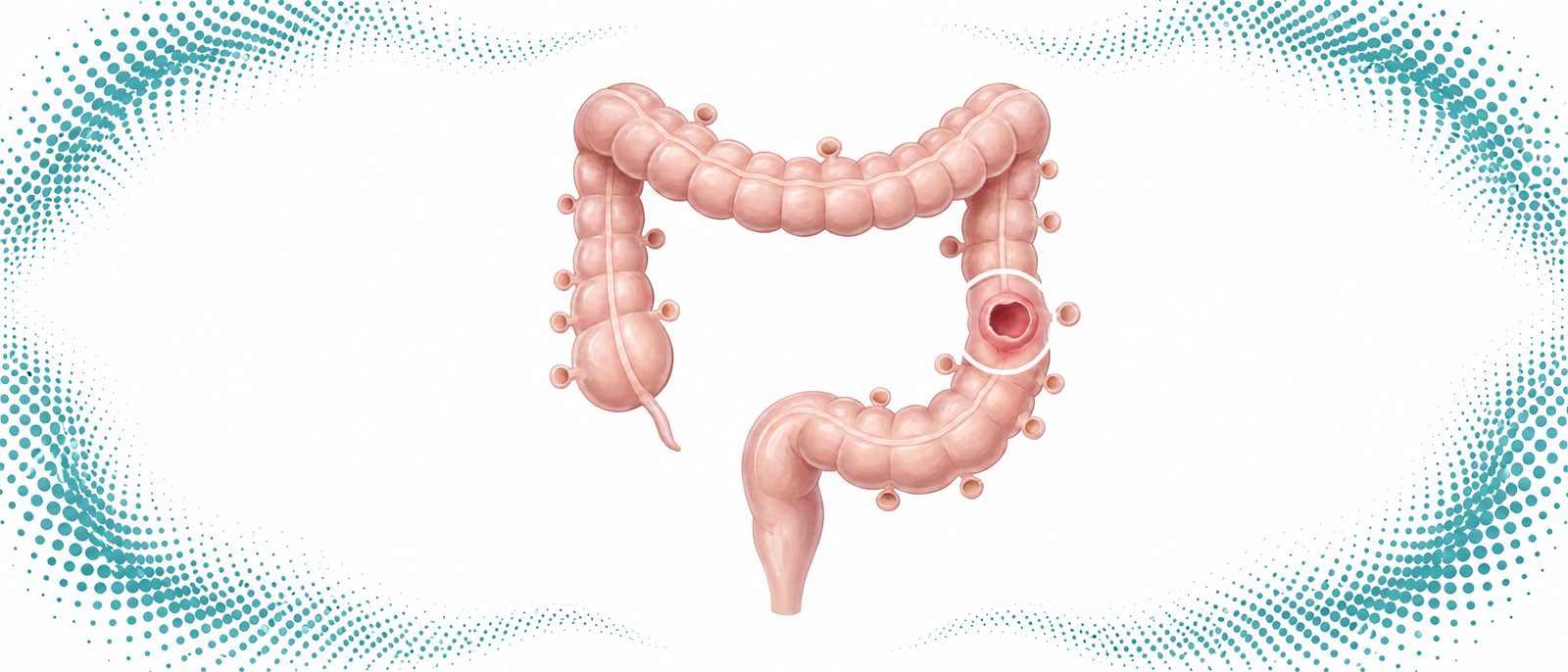 Diverticular Disease & Diverticulitis illustration