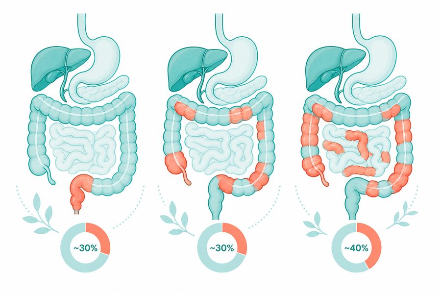 Diagram showing where Crohn's commonly occurs