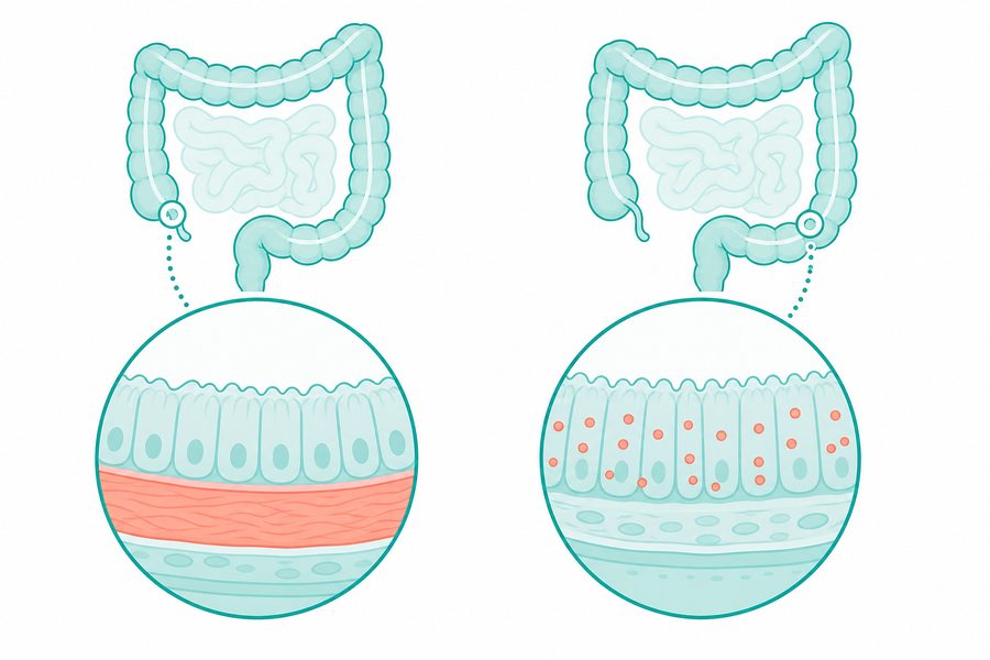 Diagram showing the two subtypes of microscopic colitis