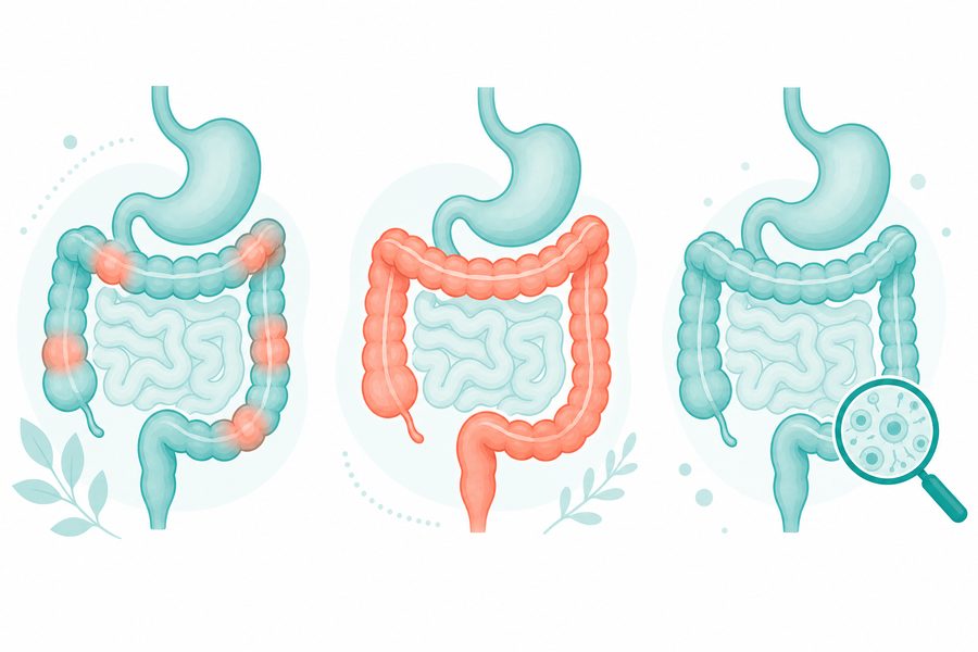 Comparison of the three types of IBD showing where each affects the gut